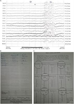 Associations between neurolinguistic deficits and personality traits in people with epilepsy